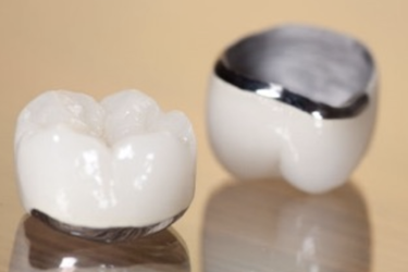 Coronas dentales - Precio y Opiniones - Dr. Ferrer