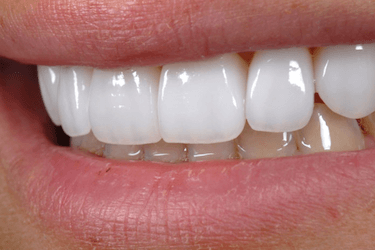 Qué carillas dentales elegir? Tipos, precios y opiniones