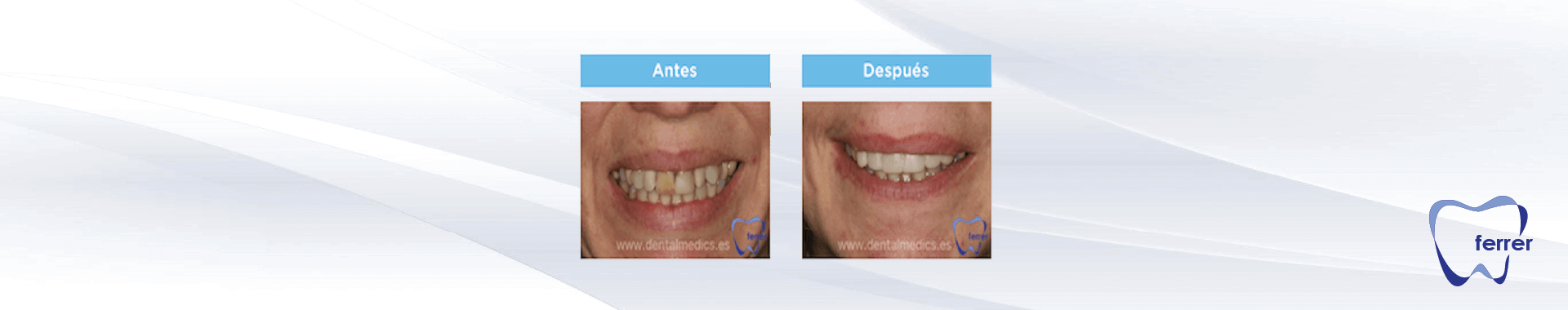 Carillas Dentales De Composite Clinica Dental Dr Ferrer