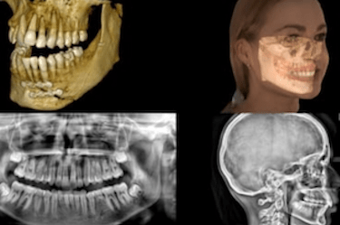 como se hace un tac dental