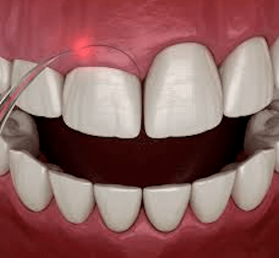  Alargamiento Coronario: todo lo que debes saber - Clínica dental Dr. Ferrer | Madrid